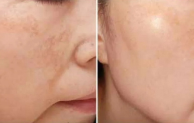 都說(shuō)祛斑難，對(duì)不起，那是他因?yàn)槟銢](méi)選對(duì)方法！